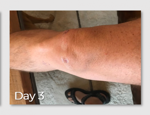 Case Study: Reflection on “Actively” Rehabbing after Medial Meniscectomy