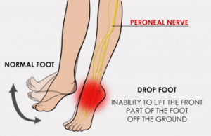 Peroneal nerve and drop foot
