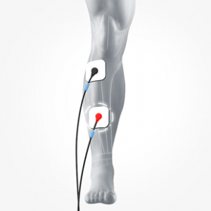 Electrode placement for biofeedback rehab for drop foot