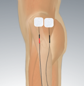 electrode placement for gluteus medius
