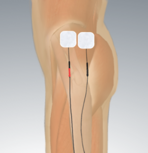 Biofeedback for Lateral Hip Pain ft. RunDNA - mTrigger