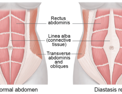 A New Approach to Treating Postpartum Diastasis Recti